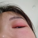 시흥안과 밝은아이안과 다래끼빨리낫는법