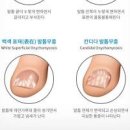 발톱 염증 냄새 무좀 발톱 증상 치료 약 레이저 이미지