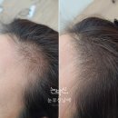진지한눈썹 | 충주눈썹문신, 불법? 합법? 최근 달라진 반영구 업계 이야기