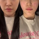 내가찾던의원 | 선릉역피부과 볼패임 걱정 없는 쥬베룩볼륨 튠페이스 (튠베룩) 받고 온 후기