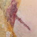 눈높이성형외과의원 | 5세 아이 계단 사고 이마 찢어짐, 주말 엔터성형외과 치료 후기