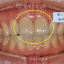 이빨 깨졌을 때 앞니깨짐, 어금니깨짐 치료 (치아 라미네이트 레진 크라운, 비용) 이미지