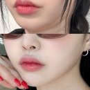 이중턱살 리프팅 울쎄라피프라임 효과 통증 가격 내돈내산 후기