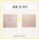 수동한의원 | 튀어나온 점 제거 후기 수술 vs 박리 한의원 살펴봐야할 점은?(돌출점제거)