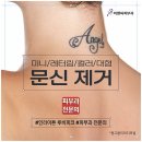 비앤씨피부과의원 | 컬러타투제거 어려운 이유는? 색상별 맞춤 파장대 적용해야