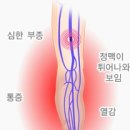 혈전증의 사망률이 암(癌)보다 높다! 이미지