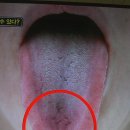각종 암 극복 사례, 혀 상태로 병을 진단한 여러 사례 이미지