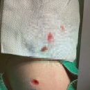 아베크 성형외과의원 | 피부섬유종 제거 리뷰 1탄