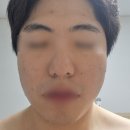 재생한의원 | 신중동역 여드름 한의원 바이오필링 재생관리 후기