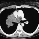 Extended pulmonary resections of advanced thoracic malignancies with support of cardiopulmonarybypass 이미지