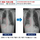 SB주사를 투여 받은 암환자에서의 효능에 대한 분석 이미지