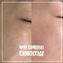 더에이치샵 | 부천피부관리 미백관리 더에이치샵 멜라스팟포인트 케어 후기