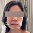 3쓰리 | 홀드랩 써마쓰리 사용 후기! 써마3 심부볼, 중안부 리프팅 효과