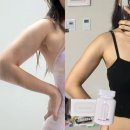 포만감 높여 식단조절 도와주는 벌룬티어 벌룬정 다이어트 후기