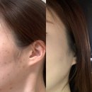 일산고운세상피부과의원 | 정발산역피부과 일산고운세상피부과 일산염증성여드름 관리로 꿀피부 만들기