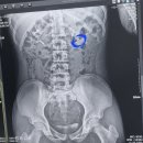 성모비뇨기과의원 | [후기] 아들이 서울바른비뇨기과에서 요로결석 쇄석술 치료받은 이야기