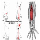 테니스엘보·손목·손가락 통증의 숨은 원인, 전완신근(Extensor Muscles) Trigger Point를 놓치지 마세요 이미지