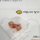 배방편안한치과의원 | 서울 사랑니 치과 매복사랑니 발치 사랑니에진심치과의원 내돈내산 추천 후기