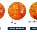 [세계 당뇨병의 날] 삼다증? 안저검사? ‘당뇨’ 속 숨은 정보 6가지 이미지