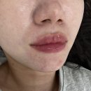 해운대에 올라 | 부산 립퍼밍 잘하는 곳｜해운대 미엘르 립 트리트먼트 케어 후기