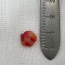 창녕경남의원 | [밀양창녕피지낭종제거] 빠른 회복을 돕는 최신 피지낭종 제거 기술 소개 !!