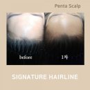 양덕동530 | 헤어라인맛집💚포항두피문신전문 펜타스칼프