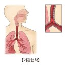 기관지 협착(사래) 이미지