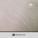 원톤스킨 - 화성시 주석로325번길 16 | 엉덩이 튼살 가리기, 자연스럽게 커버하는 시술이 있을까? 삼송역 원톤스킨 후기