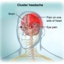 군발두통[cluster headache] 이미지
