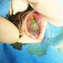 ABK- Superficial keratotomy +thermokeratoplasty +Tassoraphy 이미지