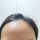 한천로139길 | [잠실새내역피부과] 수두자국 새살침효과 2주차째 후기