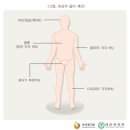 신화상치료비보장 특별약관[화상진단비보장, 화상수술비보장, 중증화상 및 부식진단비보장] 이미지