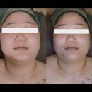 지원스킨앤바디 | [대구/달서구] 대구 상인동 피부관리샵 추천 킴그린스킨앤바디 하이푸 관리 후기