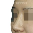 강남코성형 후 눈몰림 생기기 싫다면 보세요