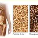 골다공증에 관한 잘못된 믿음들 이미지