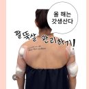 오가멍 | 노원 팔뚝 무한람스 지방분해주사 5일차 리얼 후기 (통증, 붓기, 멍)