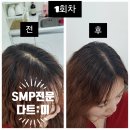 부산 정관 정수리탈모 SMP전문 다트미 1회차 후기! 두피 커버 솔직 리뷰