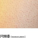 모공각화증, 닭살 피부가 아니에요! 원인과 효과적인 관리법