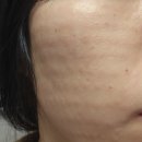 리쥬란 부작용 엠보 안사라짐?! 재생크림 추천 및 3회차 후기