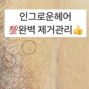 인그로운헤어 제거 후기 I 성수동 왁싱샵에서 염증 없이 관리한 꿀팁!