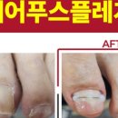 클린풋네일 & 베어푸스플레게 무좀발톱 내성발톱 발각질
