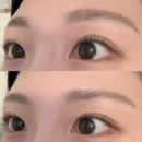 청담동피부과 아이업눈꺼풀실리프팅 내돈내산 후기/ 효과/ 전후 비교