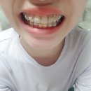 해브치과의원 | 불당치과 교정후기:D 한달 늦은 9월 후기[불당치과교정과치과의원]