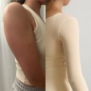 멍스타일 | 팔뚝지방흡입 허파고리 당일 후기 (병원, 붓기, 통증, 멍)