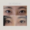 시원성형외과의원 | 절개 뒤밑트임으로 답답한 눈매를 또렷하고 시원하게 훌륭성형외과 절개 뒤밑트임 후기