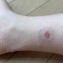 생기한의원 | 주사피부염(+ 다리 습진) 생기 한의원 내돈내산 후기