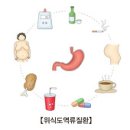 역류성식도염의 정의 이미지