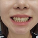 상상치과기공소 | 왜소치 앞니 무삭제라미네이트로 성숙한 입매 만든 방법