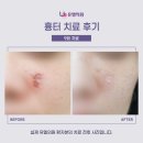 유엘의원 | [여드름 흉터 피부과] 유엘의원 시크릿레이저 &amp; 리쥬란힐러 후기