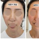 휘어 | 얼굴비대칭, 사진 찍으면 코가 더 휘어 보이나요? (5회 후기)